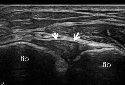 Sindesmosis tibioperonea tempo formacion ecografia 7.jpg